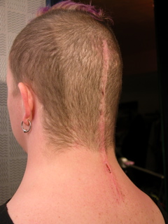 Incision as of May 23
